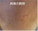 国内でも先進的な低侵襲頚椎前方手術を導入